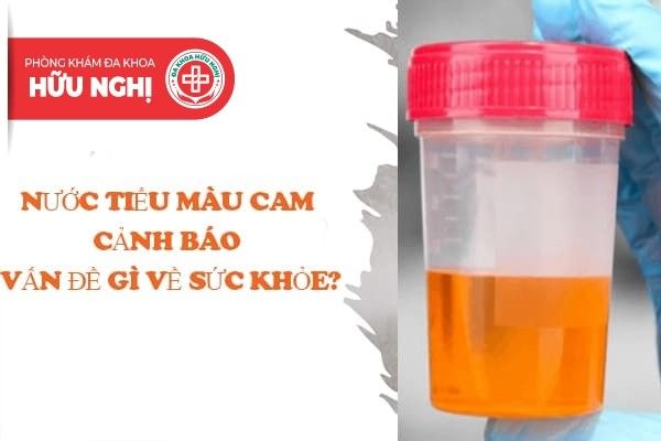 Tìm hiểu về nước tiểu màu cam - nguyên nhân và cách điều trị