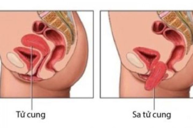 Tất tần tật thông tin về sa cổ tử cung: Nguyên nhân, triệu chứng và cách điều trị