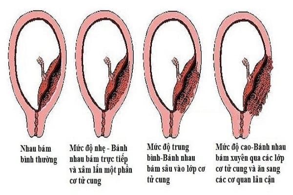 Sót nhau thai có nguy hiểm không? Chuyên gia sẽ giải đáp thắc mắc của bạn