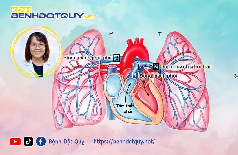 Tăng áp phổi - Cách phòng ngừa và điều trị hiệu quả