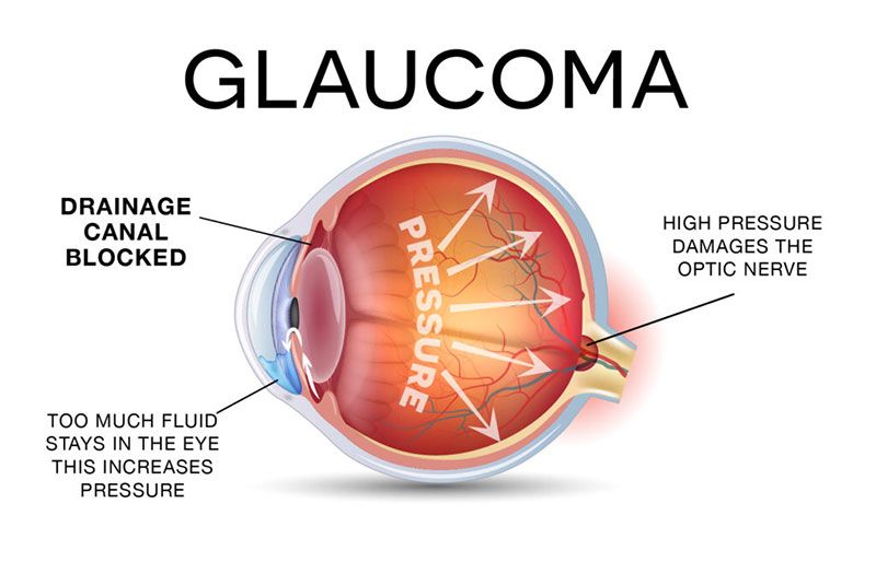 Tăng nhãn áp là gì? Tìm hiểu và phòng tránh