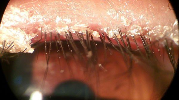 Thuốc điều trị ký sinh trùng Demodex hiệu quả nhất trong năm 2021