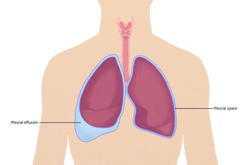 Tràn Dịch Màng Phổi Có Chữa Được Không? Những Giải Pháp Hiệu Quả