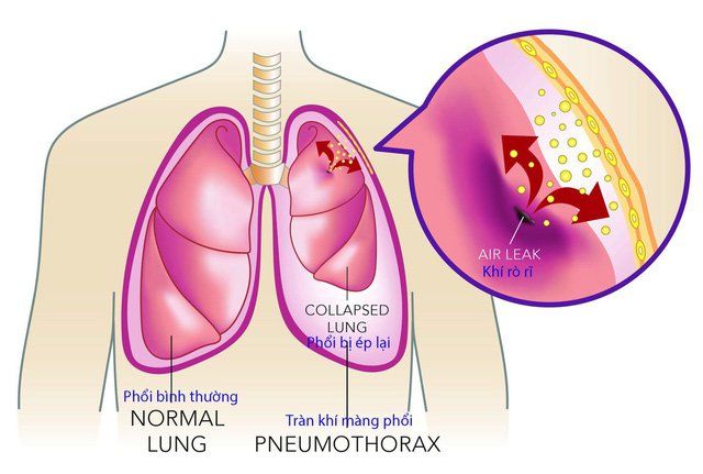 Tràn khí màng phổi tự phát: Nguyên nhân, triệu chứng và phương pháp điều trị hiệu quả