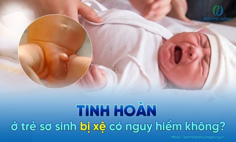 Tìm hiểu về trẻ sơ sinh bị xệ má: Nguyên nhân, triệu chứng và cách chăm sóc