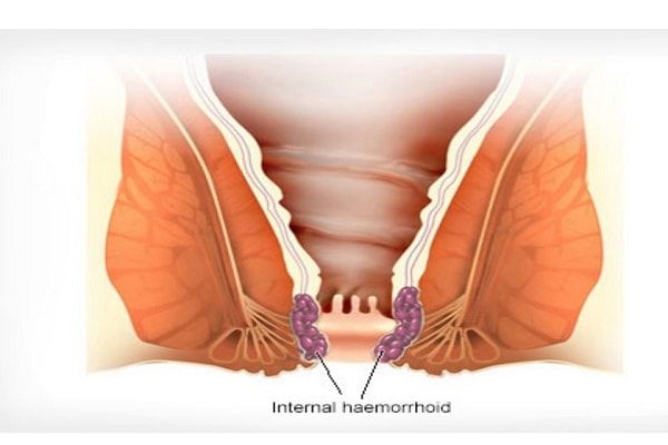 All You Need to Know About Hemorrhoids in English