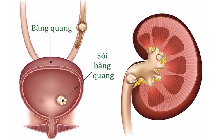 Tìm hiểu triệu chứng sỏi bàng quang và cách điều trị hiệu quả