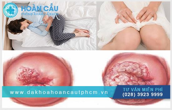 Tìm hiểu thông tin về viêm cổ tử cung nặng và cách phòng ngừa hiệu quả