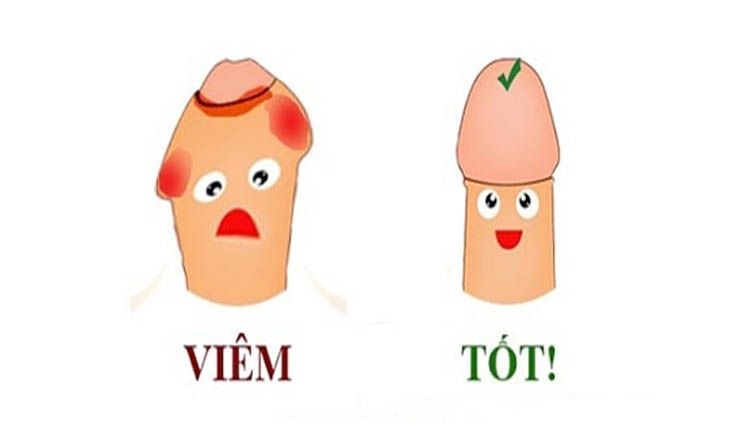 Tất tần tật thông tin về viêm da quy đầu