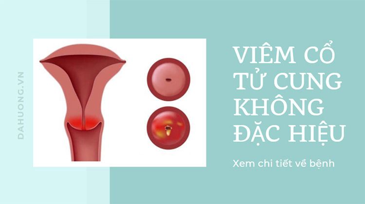 Tất tần tật thông tin về viêm không đặc hiệu cổ tử cung