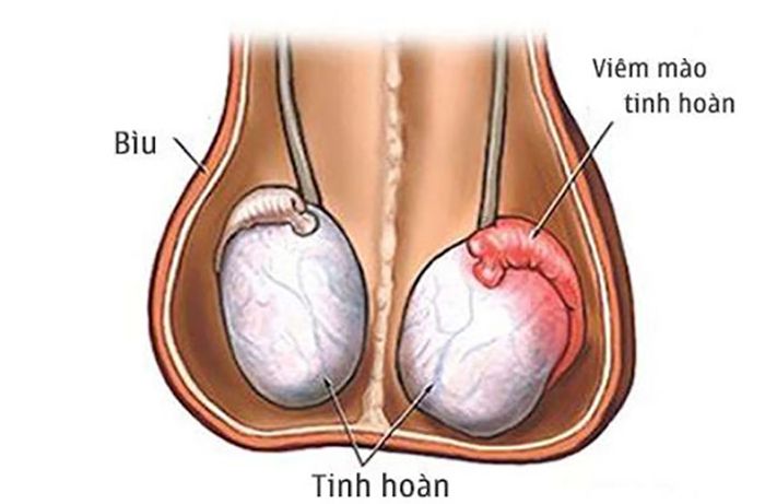 Viêm Tinh Hoàn Uống Thuốc Gì? Những Loại Thuốc Hiệu Quả Nhất