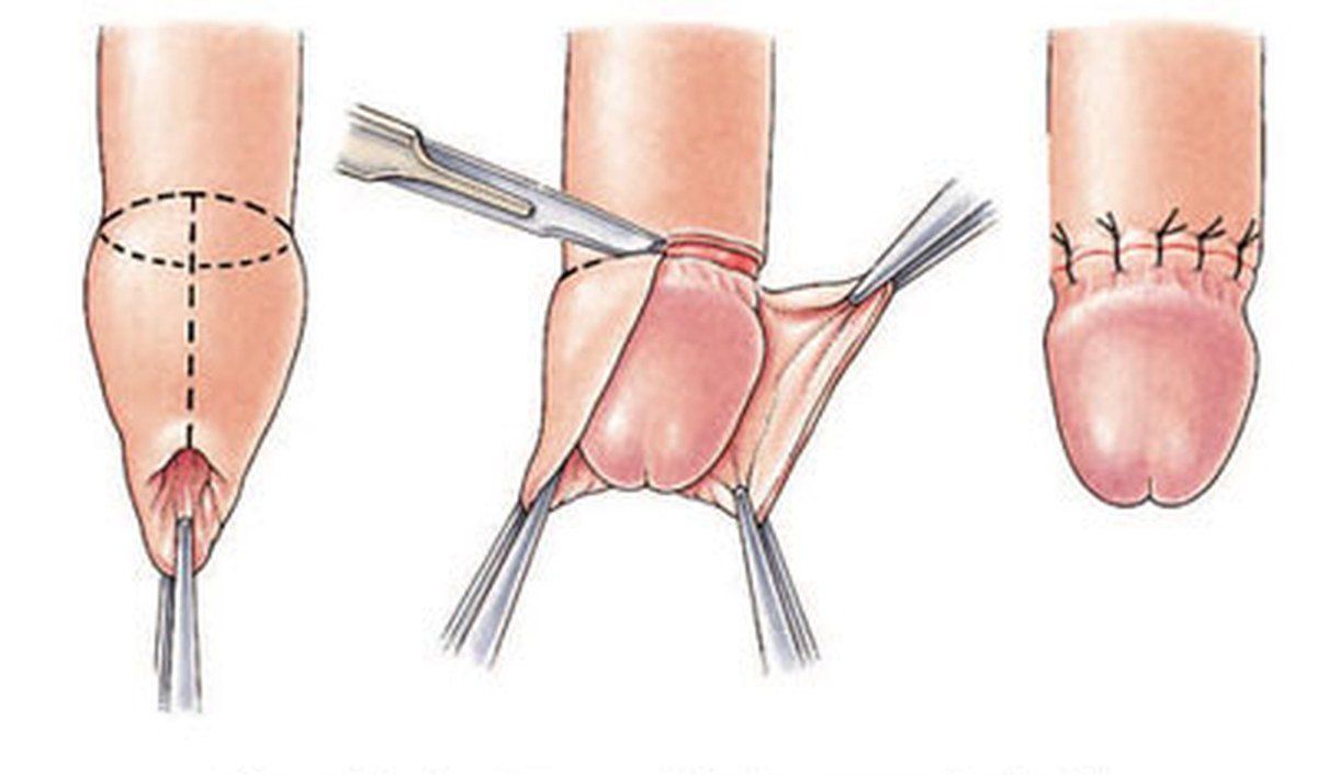 Viêm xơ quy đầu: nguyên nhân, triệu chứng và cách điều trị hiệu quả