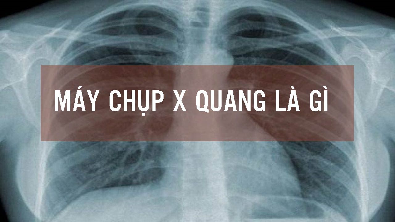 Tìm hiểu về x quang là gì và những thông tin cần biết