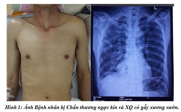 Xử trí gãy xương sườn - Các phương pháp và lời khuyên từ các chuyên gia