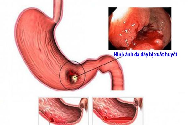 Xuất huyết dạ dày - có thể được chữa khỏi hay không? Cùng tìm hiểu!