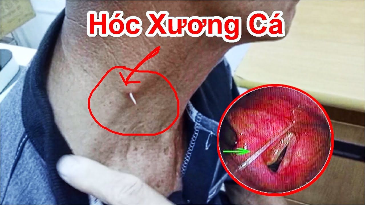 Xương cá dính cổ họng - Thông tin và cách xử lý khi gặp vấn đề